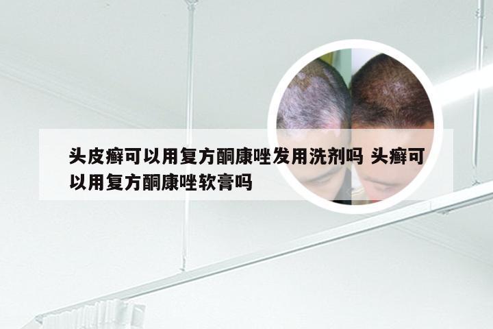 头皮癣可以用复方酮康唑发用洗剂吗 头癣可以用复方酮康唑软膏吗