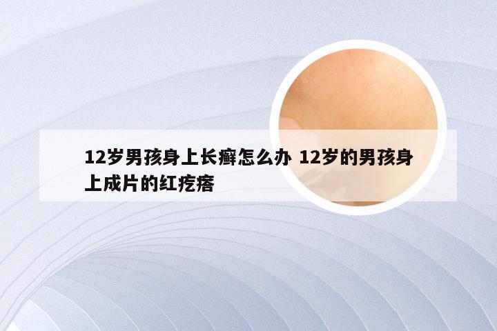 12岁男孩身上长癣怎么办 12岁的男孩身上成片的红疙瘩