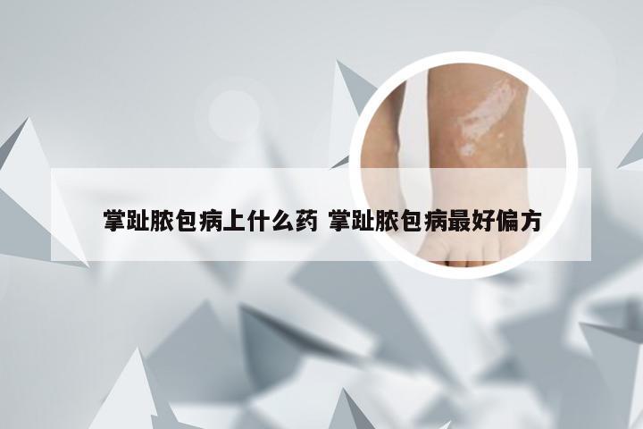 掌趾脓包病上什么药 掌趾脓包病最好偏方