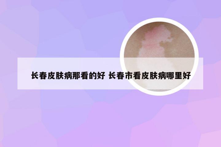 长春皮肤病那看的好 长春市看皮肤病哪里好