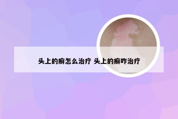 头上的癣怎么治疗 头上的癣咋治疗