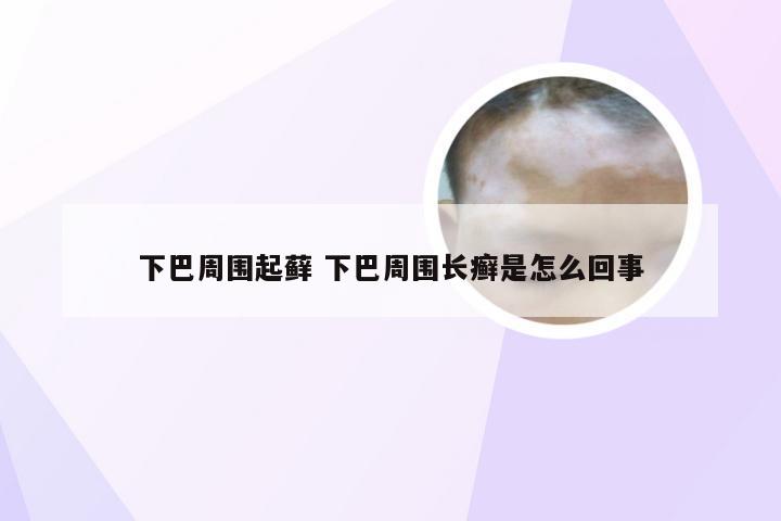 下巴周围起藓 下巴周围长癣是怎么回事