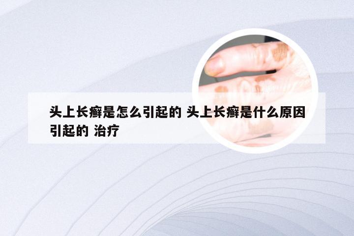 头上长癣是怎么引起的 头上长癣是什么原因引起的 治疗