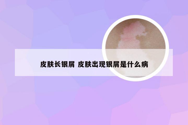 皮肤长银屑 皮肤出现银屑是什么病