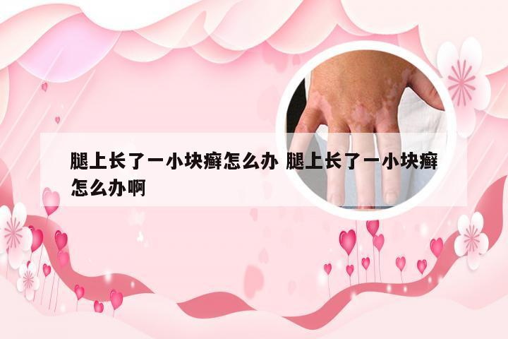 腿上长了一小块癣怎么办 腿上长了一小块癣怎么办啊