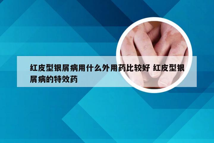 红皮型银屑病用什么外用药比较好 红皮型银屑病的特效药