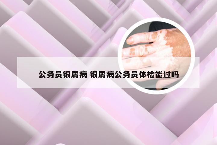 公务员银屑病 银屑病公务员体检能过吗