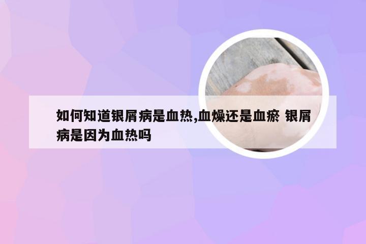 如何知道银屑病是血热,血燥还是血瘀 银屑病是因为血热吗