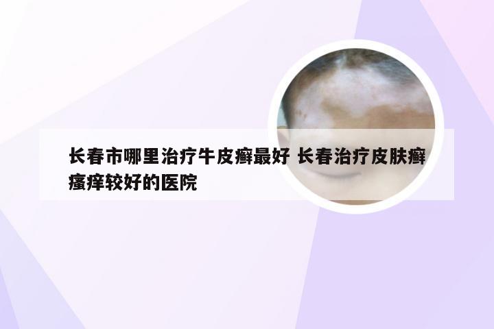 长春市哪里治疗牛皮癣最好 长春治疗皮肤癣瘙痒较好的医院