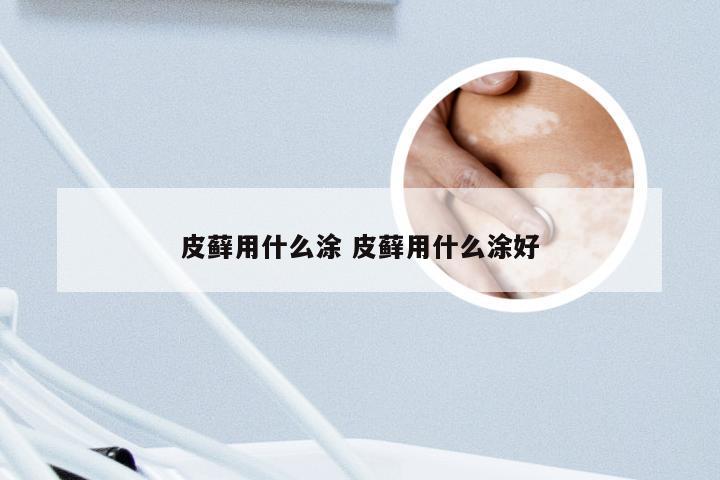 皮藓用什么涂 皮藓用什么涂好