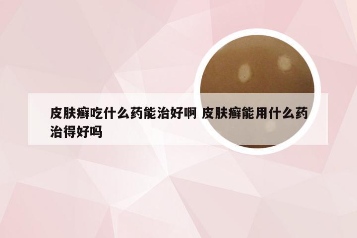 皮肤癣吃什么药能治好啊 皮肤癣能用什么药治得好吗