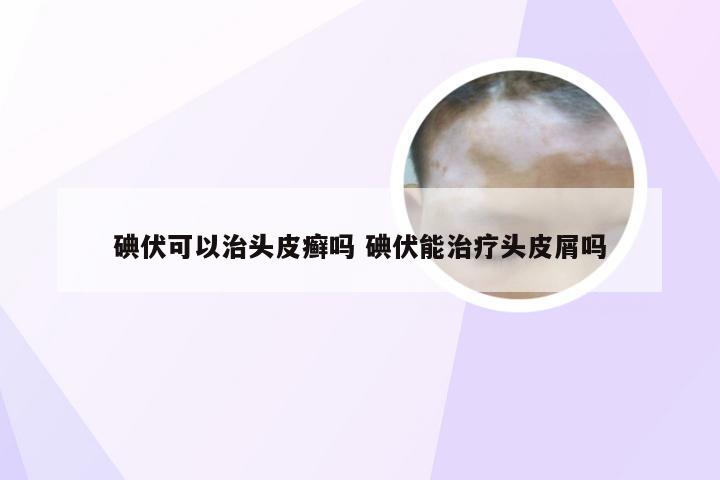 碘伏可以治头皮癣吗 碘伏能治疗头皮屑吗