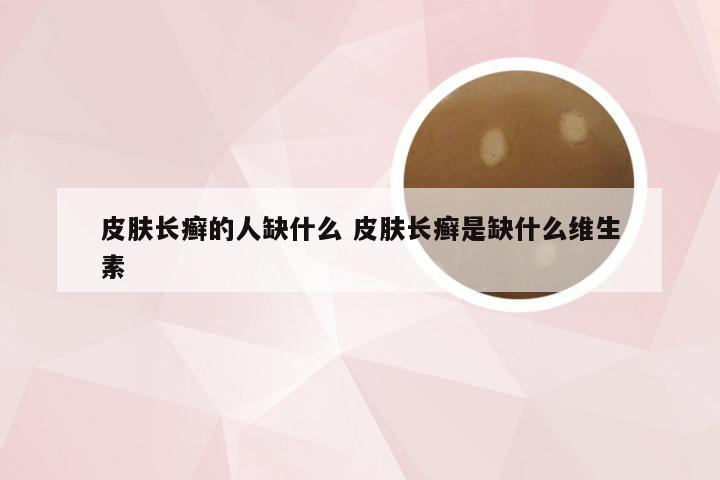 皮肤长癣的人缺什么 皮肤长癣是缺什么维生素