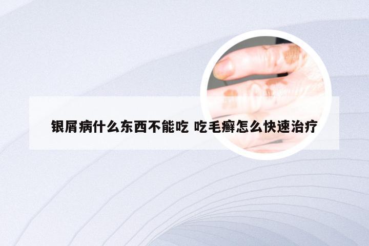 银屑病什么东西不能吃 吃毛癣怎么快速治疗