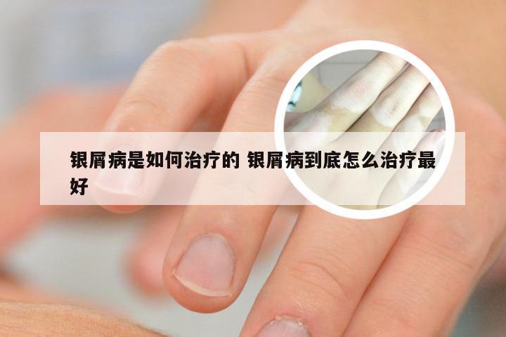 银屑病是如何治疗的 银屑病到底怎么治疗最好