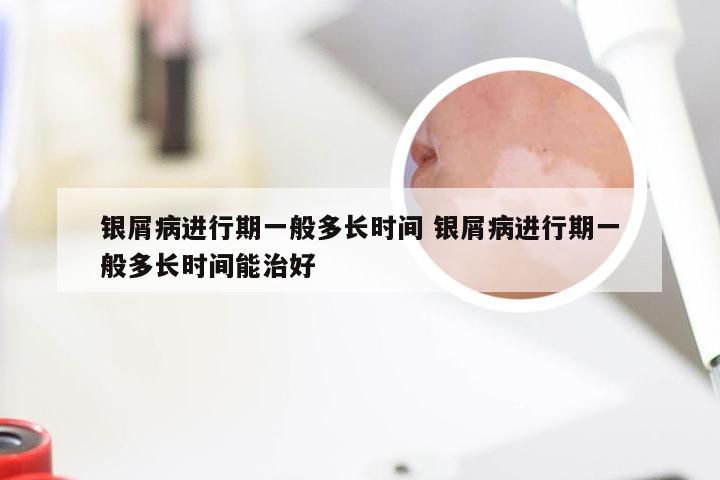 银屑病进行期一般多长时间 银屑病进行期一般多长时间能治好