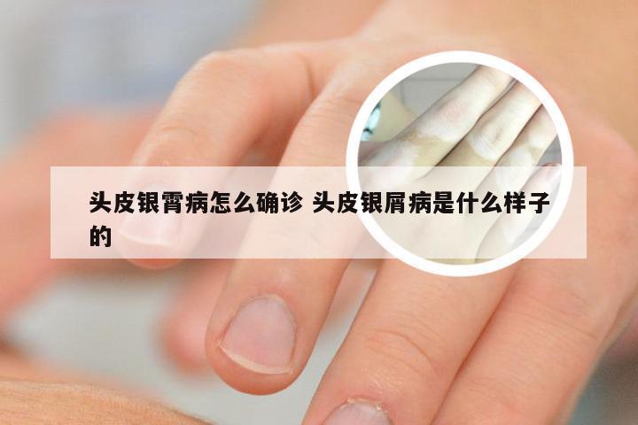 头皮银霄病怎么确诊 头皮银屑病是什么样子的