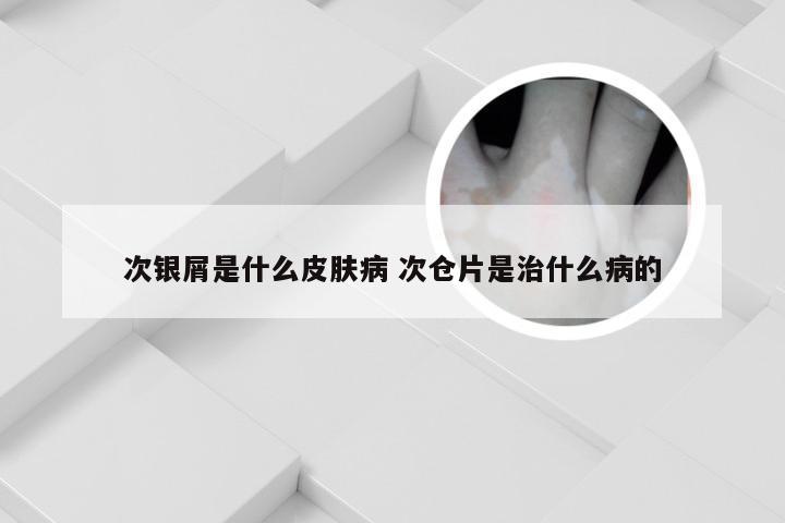 次银屑是什么皮肤病 次仓片是治什么病的