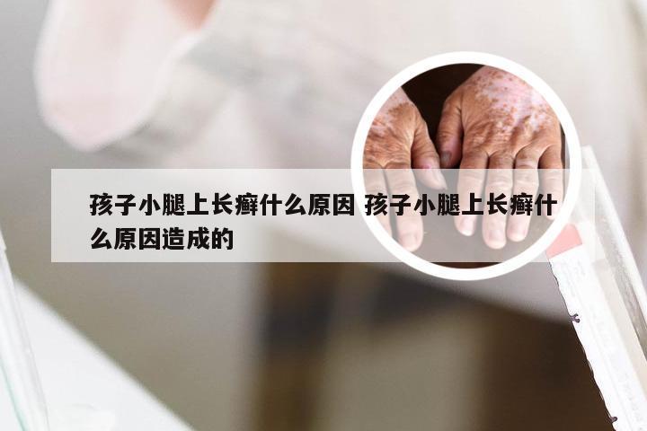 孩子小腿上长癣什么原因 孩子小腿上长癣什么原因造成的