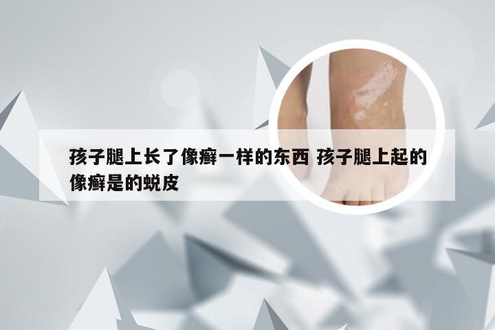 孩子腿上长了像癣一样的东西 孩子腿上起的像癣是的蜕皮