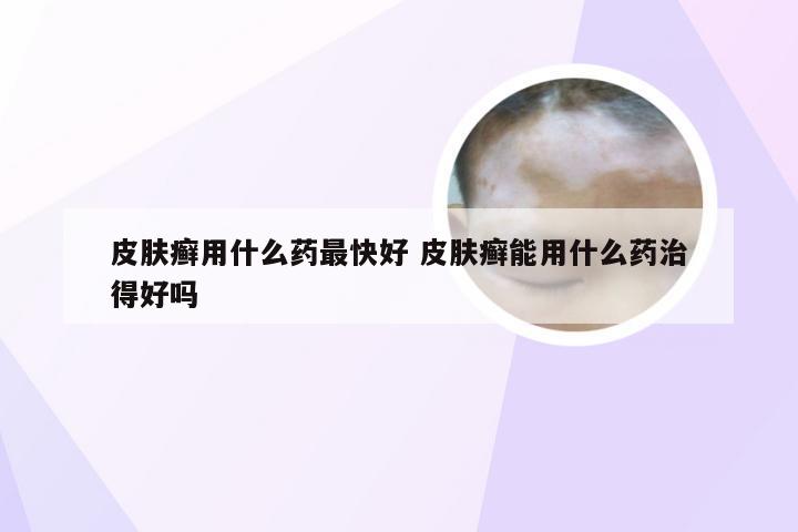 皮肤癣用什么药最快好 皮肤癣能用什么药治得好吗