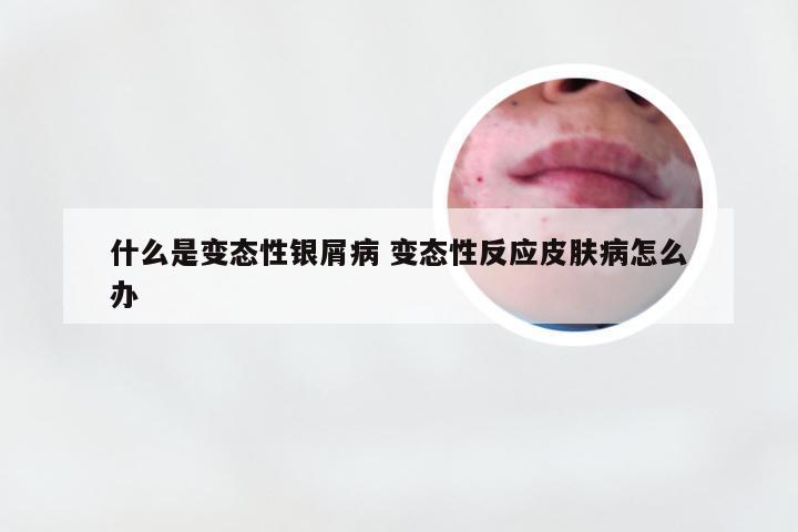 什么是变态性银屑病 变态性反应皮肤病怎么办