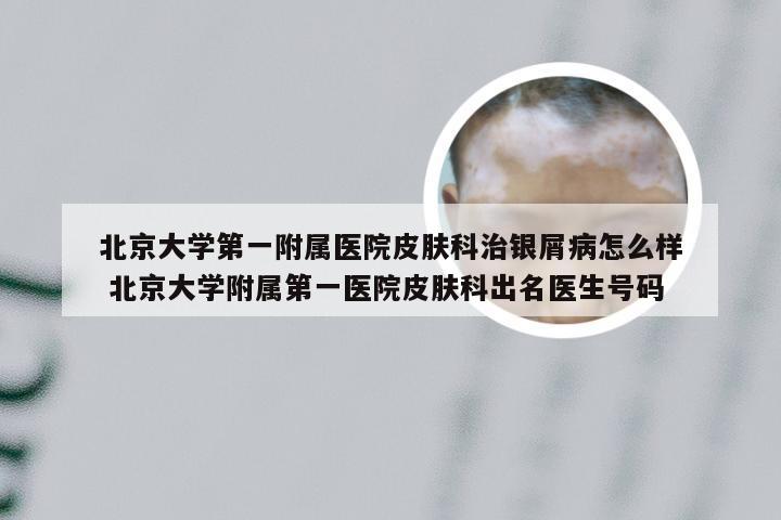 北京大学第一附属医院皮肤科治银屑病怎么样 北京大学附属第一医院皮肤科出名医生号码