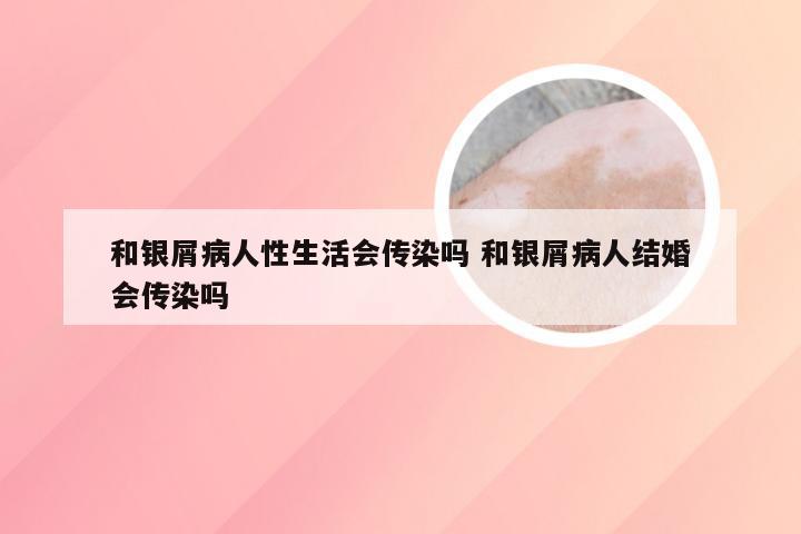 和银屑病人性生活会传染吗 和银屑病人结婚会传染吗