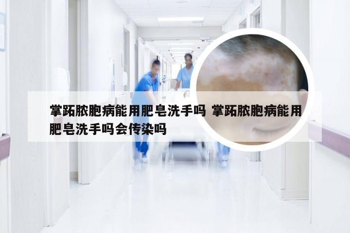 掌跖脓胞病能用肥皂洗手吗 掌跖脓胞病能用肥皂洗手吗会传染吗