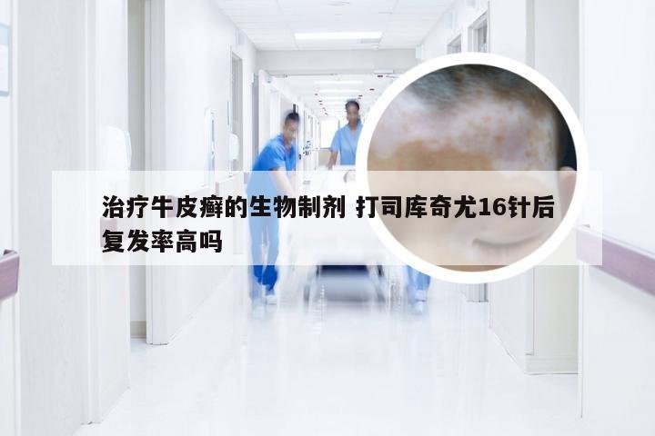 治疗牛皮癣的生物制剂 打司库奇尤16针后复发率高吗