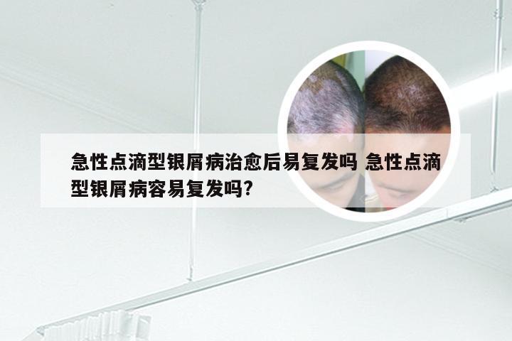 急性点滴型银屑病治愈后易复发吗 急性点滴型银屑病容易复发吗?