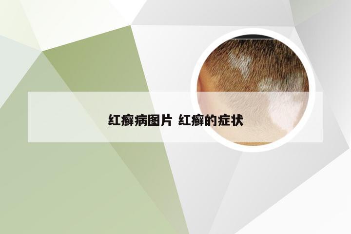 红癣病图片 红癣的症状