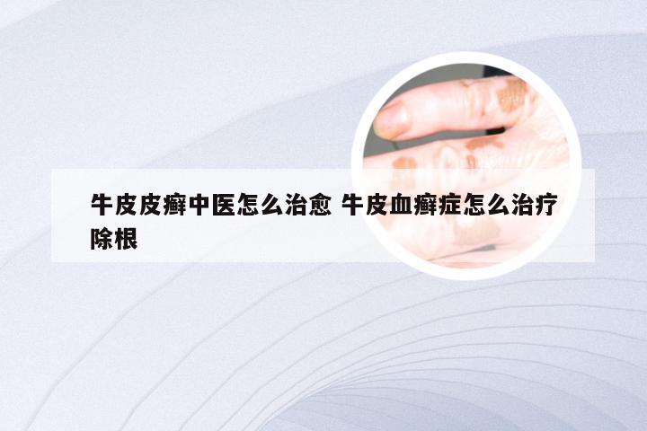 牛皮皮癣中医怎么治愈 牛皮血癣症怎么治疗除根