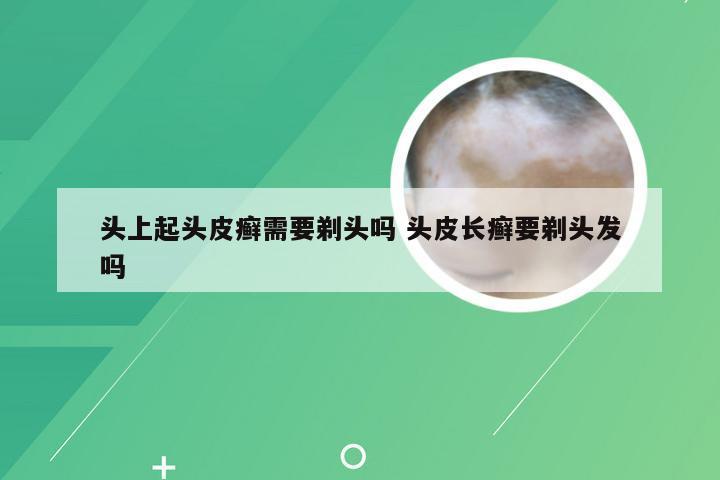 头上起头皮癣需要剃头吗 头皮长癣要剃头发吗