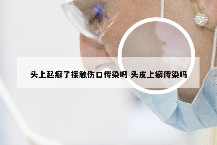 头上起癣了接触伤口传染吗 头皮上癣传染吗