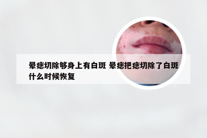 晕痣切除够身上有白斑 晕痣把痣切除了白斑什么时候恢复