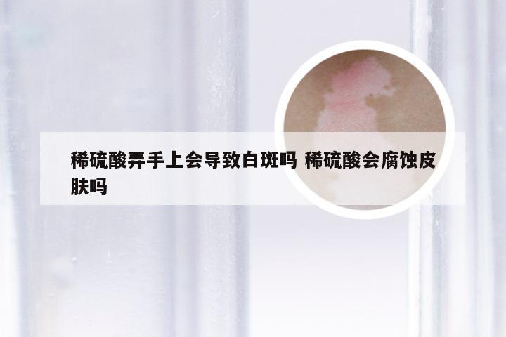 稀硫酸弄手上会导致白斑吗 稀硫酸会腐蚀皮肤吗