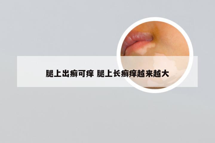 腿上出癣可痒 腿上长癣痒越来越大