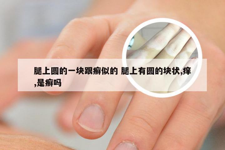 腿上圆的一块跟癣似的 腿上有圆的块状,痒,是癣吗