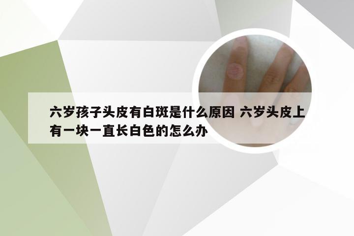 六岁孩子头皮有白斑是什么原因 六岁头皮上有一块一直长白色的怎么办