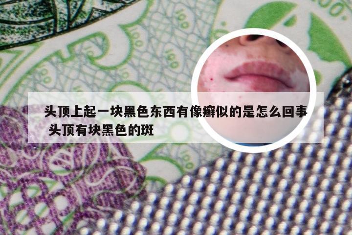 头顶上起一块黑色东西有像癣似的是怎么回事 头顶有块黑色的斑