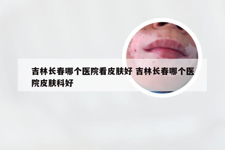 吉林长春哪个医院看皮肤好 吉林长春哪个医院皮肤科好