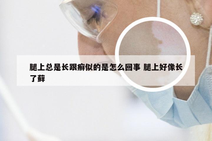 腿上总是长跟癣似的是怎么回事 腿上好像长了藓