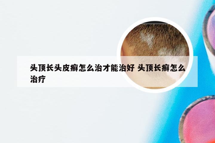 头顶长头皮癣怎么治才能治好 头顶长癣怎么治疗