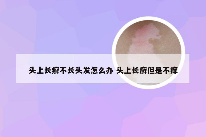 头上长癣不长头发怎么办 头上长癣但是不痒