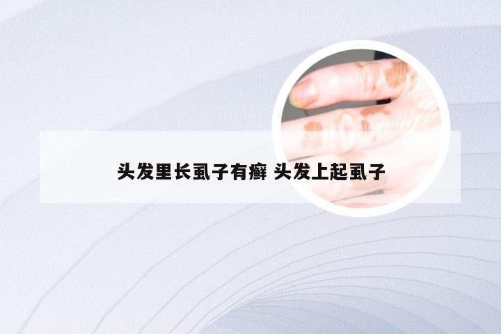 头发里长虱子有癣 头发上起虱子