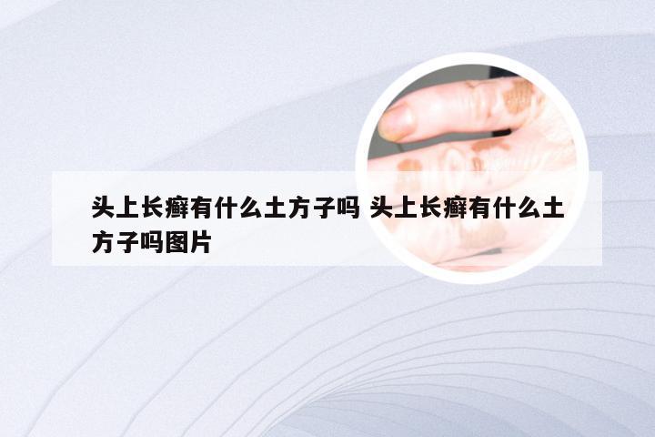 头上长癣有什么土方子吗 头上长癣有什么土方子吗图片