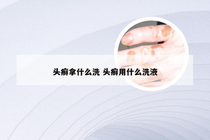 头癣拿什么洗 头癣用什么洗液