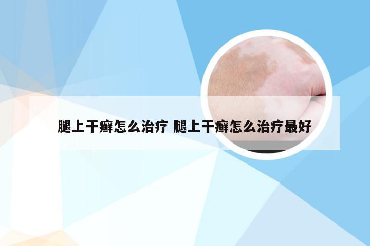 腿上干癣怎么治疗 腿上干癣怎么治疗最好