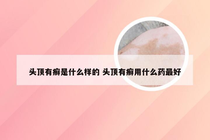 头顶有癣是什么样的 头顶有癣用什么药最好